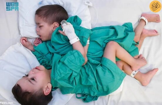 جداسازی دوقلوهای بههم چسبیده