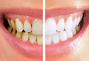 ۱۰ روش‌ موثر برای سفید کردن دندان با مواد طبیعی