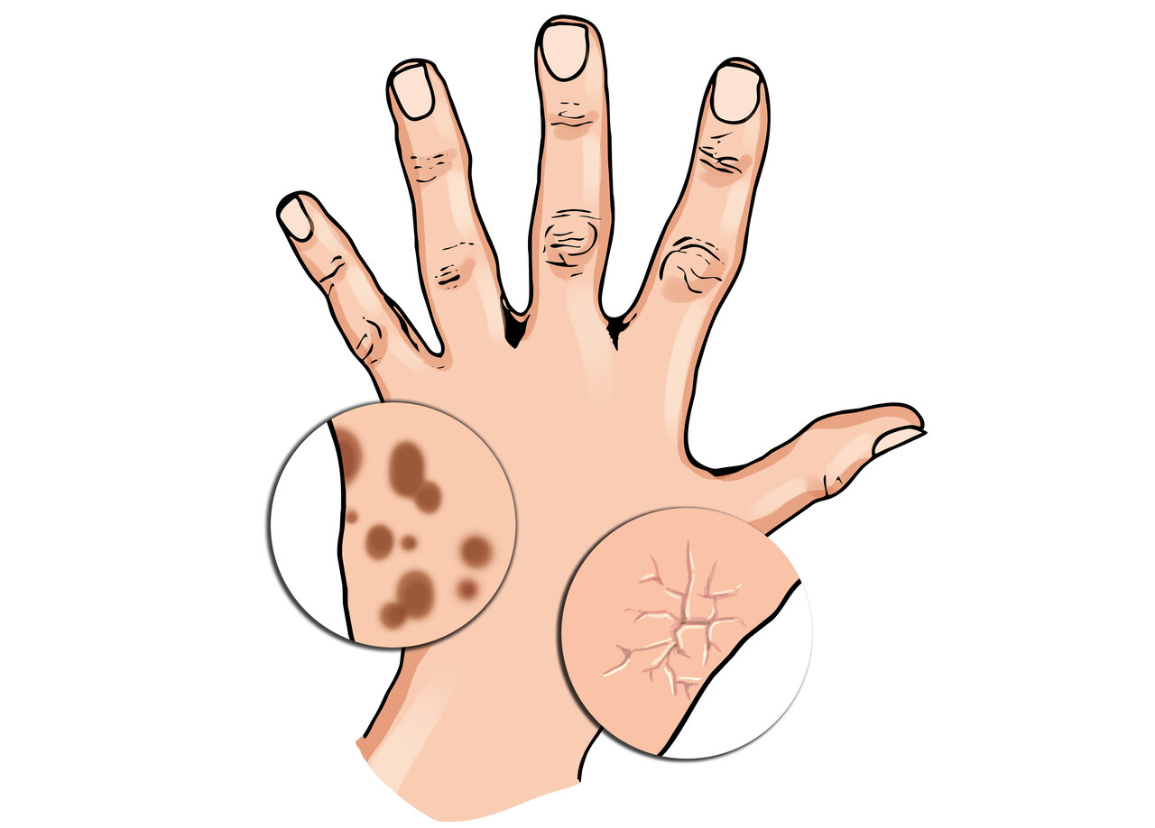 هشت علامت در دست و ناخنها که نشانه از بیماری شماست