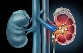 جدیدترین متد جراحی سنگ کلیه| خبر خوب و امیدوار کننده برای کلیههای سنگ ساز| کاهش عملکرد کلیه با هر بار دفع سنگ