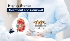 جدیدترین متد جراحی سنگ کلیه| خبر خوب و امیدوار کننده برای کلیههای سنگ ساز| کاهش عملکرد کلیه با هر بار دفع سنگ