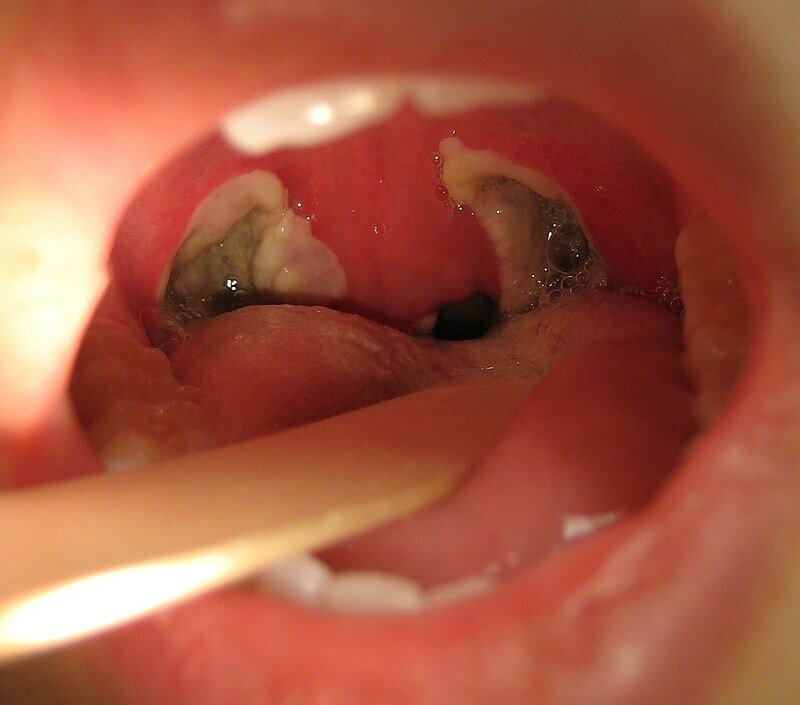 TONSILECTOMY