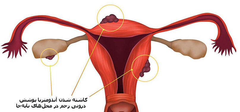 آندومتریوز؛ علل بروز و درمان| ارتباط آندومتریوز با نازایی| آیا این بیماری باعث ناباروری میشود؟