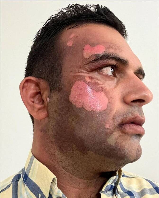 عکس | سوزاندن صورت محیط بان مازندرانی توسط یک شکارچی | تصویر دردناک صورت این محیط بان را ببینید