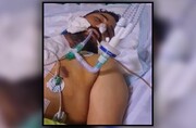 تصاویر + ۱۸ | اولین پیوند سر در ایران ؛ قطع کامل عروق گردن و نای | چهارمین جراحی موفقیت‌آمیز در جهان ؛ جوان ۲۸ ساله به هوش آمده و حرف می‌زند