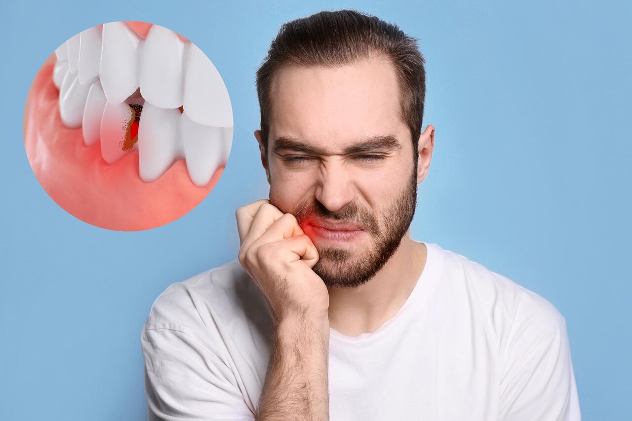 بهداشت دندان - دندانپزشکی - پوسیدگی دندان