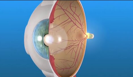مهمترین علل کم بینایی؛ این بیماری بینایی و دید مرکزی را تار می‌کند