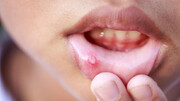 بهترین روش‌های درمان آفت دهان | لیموترش برای درمان آفت دهان معجزه می‌کند؟