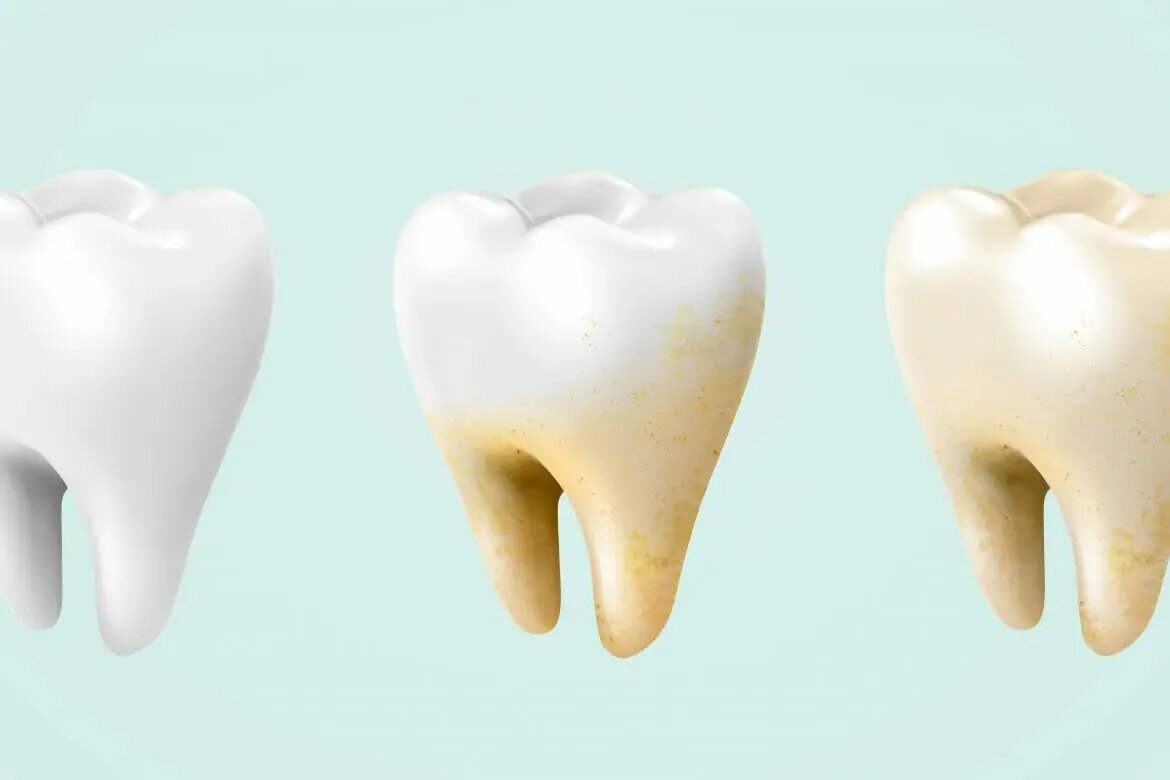 علت زرد شدن دندان -  زرد شدن دندان نیش