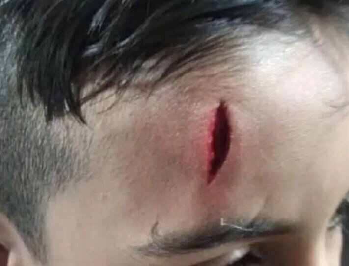 اخراج معلم به دلیل تنبیه بدنی یک دانشآموز ؛ تصویر دردناک کودکی که صورتش پاره شد | عیادت مسئولان آموزش و پرورش از دانشآموز آسیبدیده