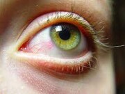 آیا ممکن است داروها عامل خشکی چشم باشند؟