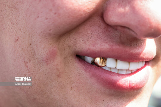 پسر دندان طلا