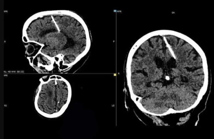 سی تی اسکن مغز سوزن