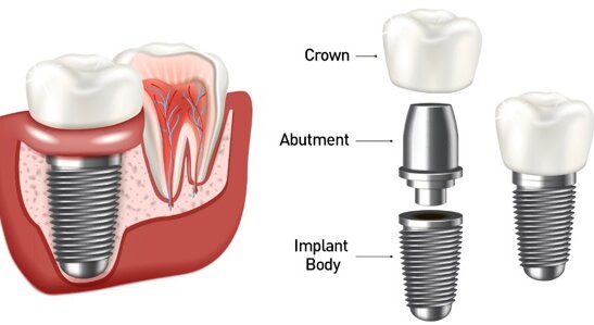 ساختار اصلی ایمپلنت دندان