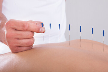 طب سوزنی برای سیاتیک؛ آیا سوزن‌ها از قرص‌ها مؤثرترند؟
