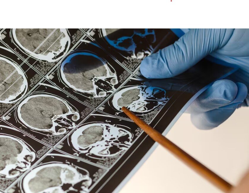 زمان طلایی برای درمان سکته مغزی | به راحتی از سکته مغزی پیشگیری کنید