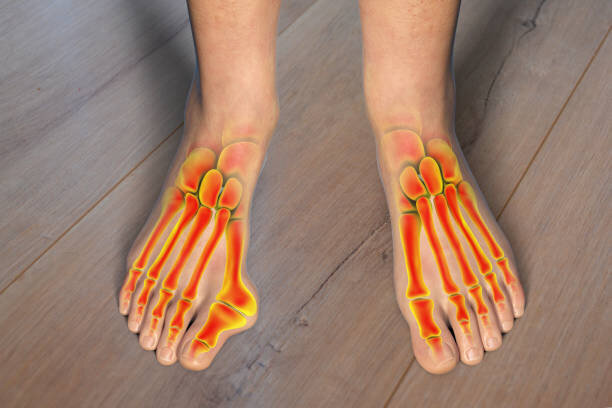 انگشت شست پای کج چیست ؟ ؛ عواملی که آن را تشدید می‌کند | چرا انگشت شست پا کج می‌شود