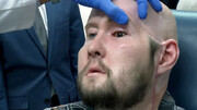 نخستین پیوند چشم کامل انسان در آمریکا انجام شد | بیمار: حس خوبی دارم