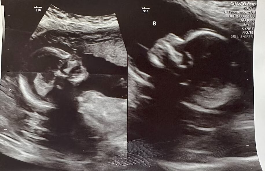 زنی دارای دو رحم در موردی بسیار نادر درون هر دوی آنها بچهدار شد