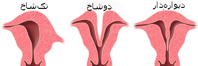 زنی دارای دو رحم در موردی بسیار نادر درون هر دوی آنها بچهدار شد