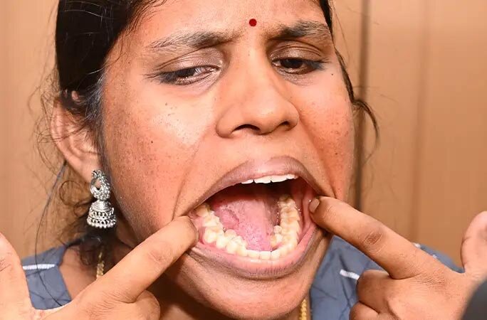 رکورد دندان زن هندی