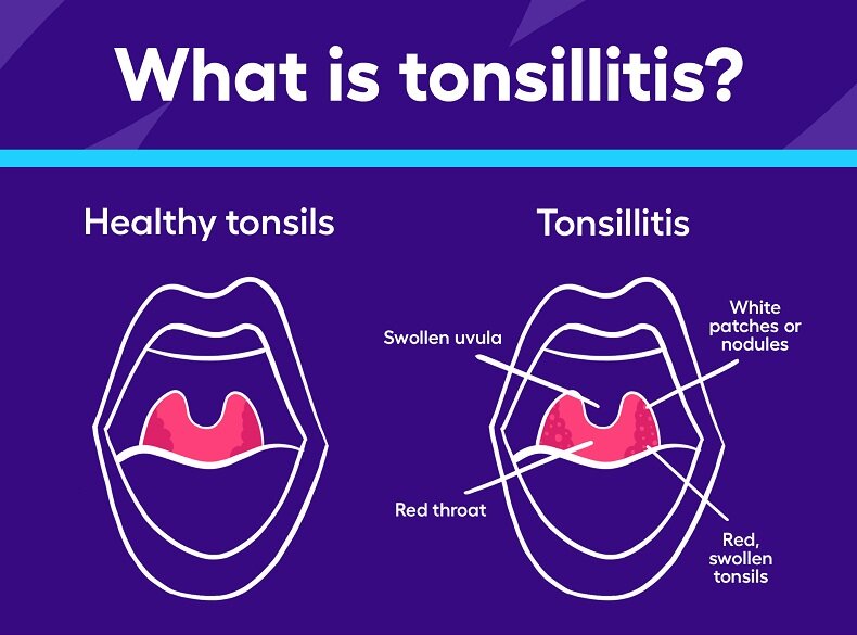 ۳ گلو درد رایج پاییز و زمستان را بشناسید | راهکارهای متخصصان برای درمان گلو درد و عفونتهای ویروسی