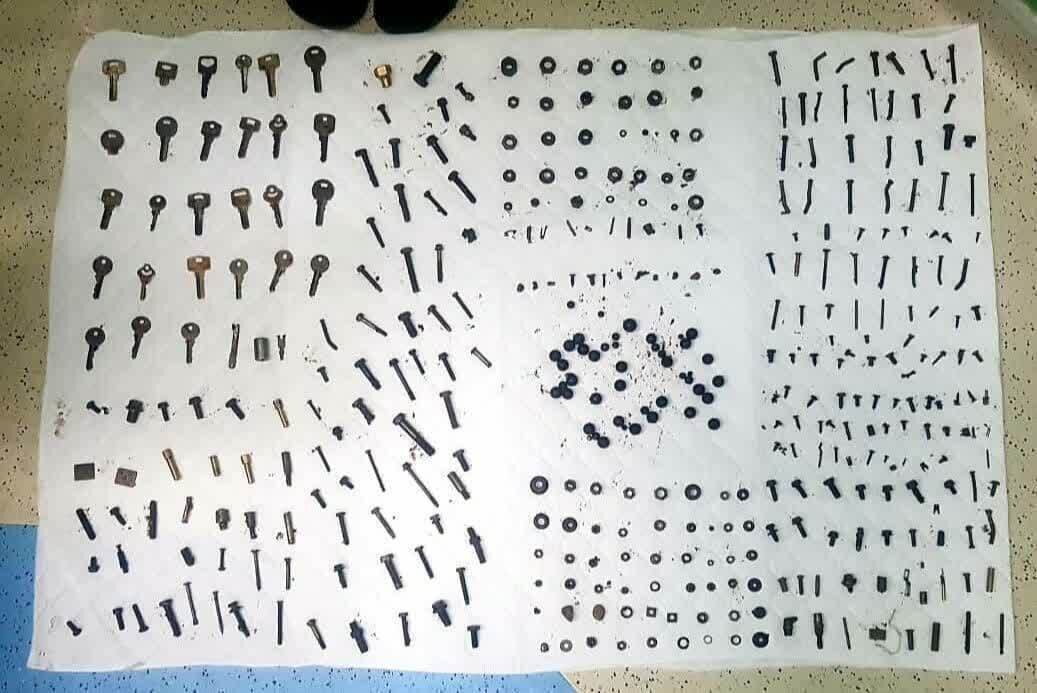 خارج کردن پیچ و مهره از شکم بیمار