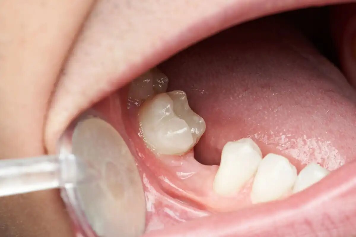 خطرات نداشتن دندان برای سلامت و بهداشت دهان