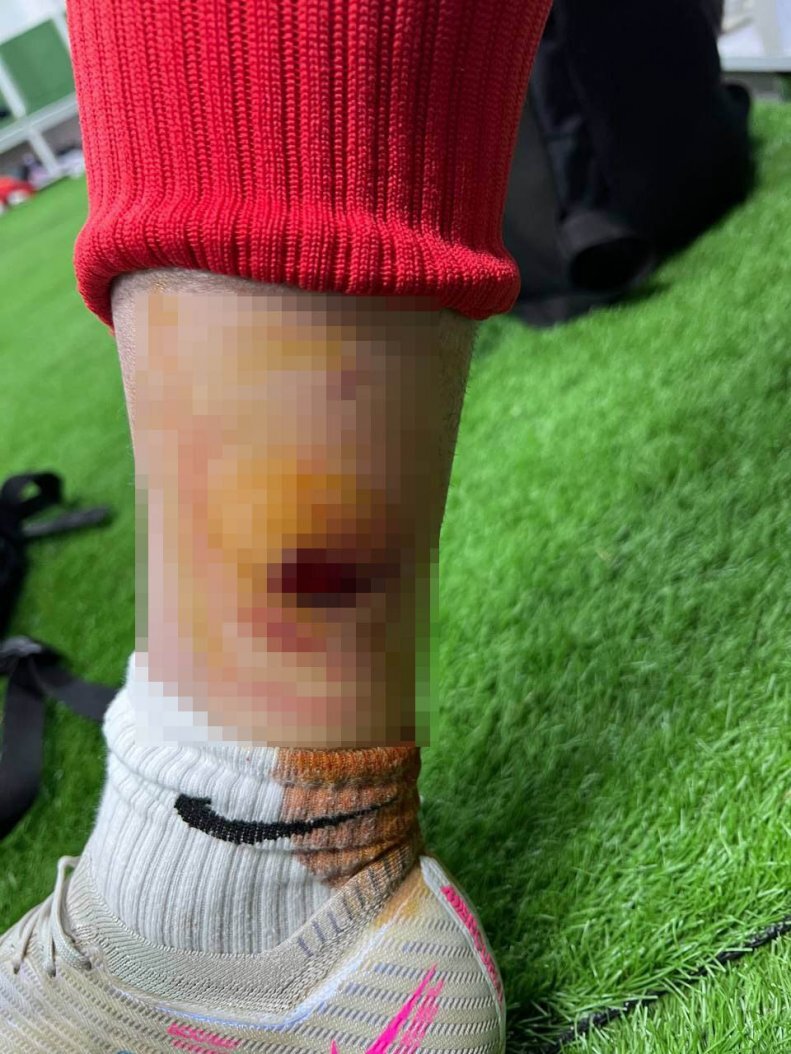 این نارنجک روی پای مدافع پرسپولیس ترکید ؛ آسیب پای چپ به شکلی عجیب + عکس