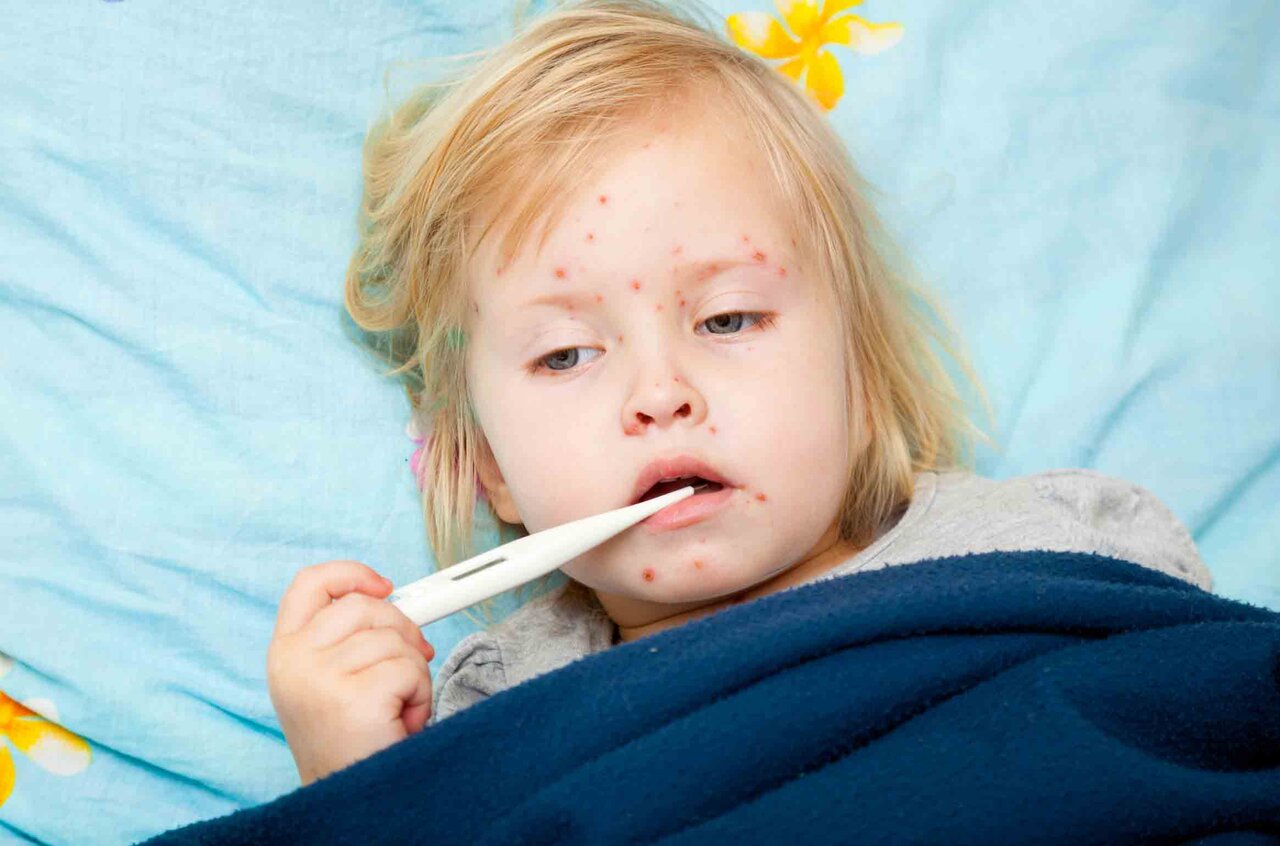 بایدها و نبایدهای آبله مرغان ؛ آبله مرغان تا چند روز واگیر دارد ؟