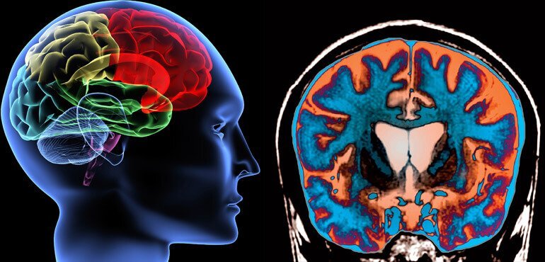 لیست بیماریهای مغز و اعصاب