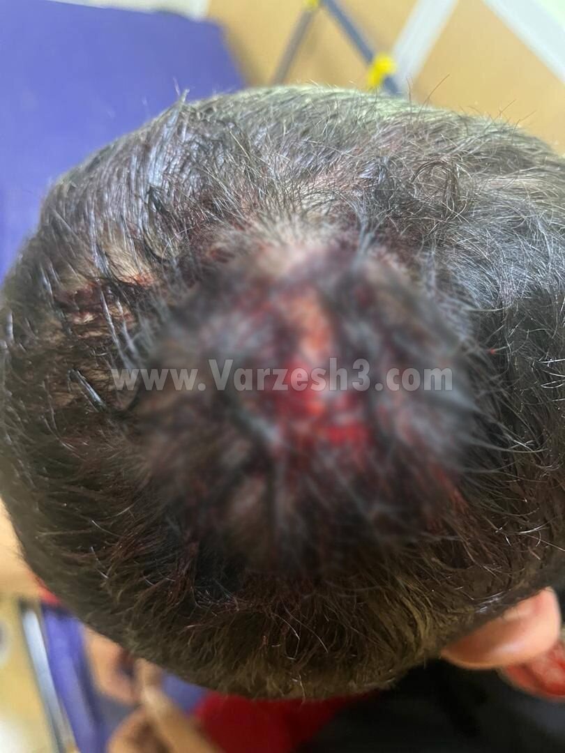 تصویری دردناک از بلایی که بازیکن ذوب آهن بر سر مدافع پرسپولیس آورد