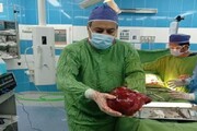 در یک عمل نادر جراحی، تومور ۳.۵ کیلویی از کلیه یک بیمار خارج شد + عکس