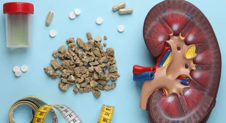 با این کارها از سنگ کلیه در امان بمانید