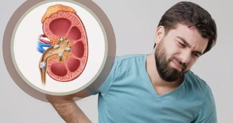 این نوشیدنی پرطرفدار خطر تشکیل سنگ کلیه را افزایش می دهد