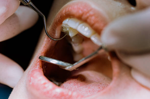 ارتباط آجیل و تنقلات نوروزی با پوسیدگی دندان | بدون این ماده معدنی مسواک نزنید