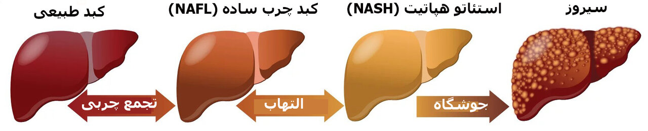 تایید دارویی که میتواند کبد چرب را درمان کند