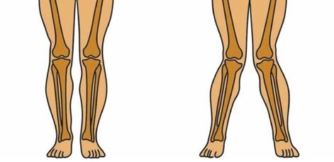 روش های درمان زانوی ضربدری