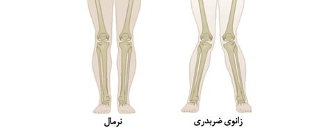 روش های درمان زانوی ضربدری