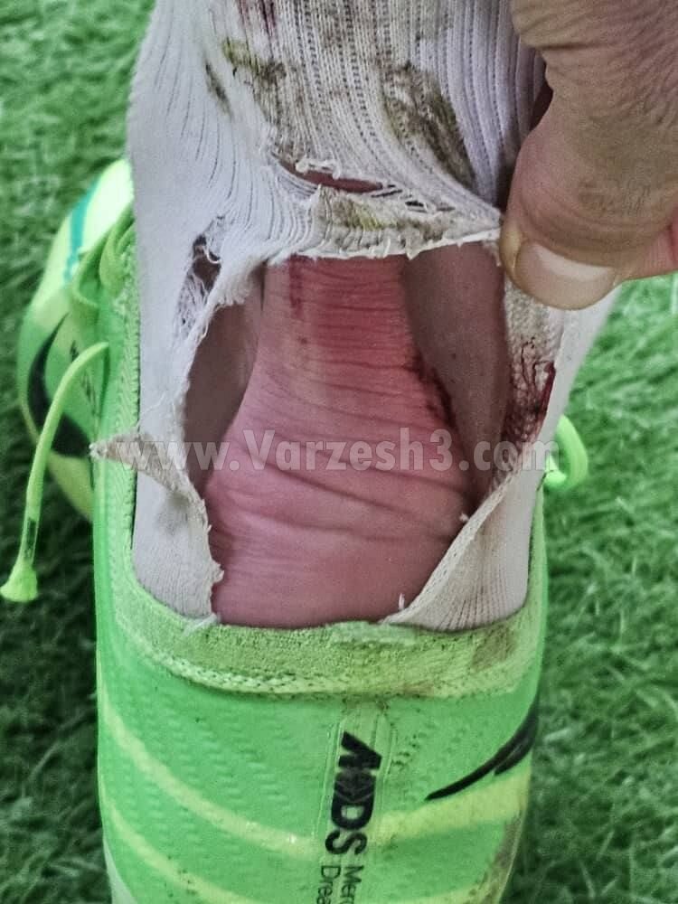 علت اصلی تعویض اورونوف مقابل آلومینیوم مشخص شد | تصویر دردناک منتشر شد