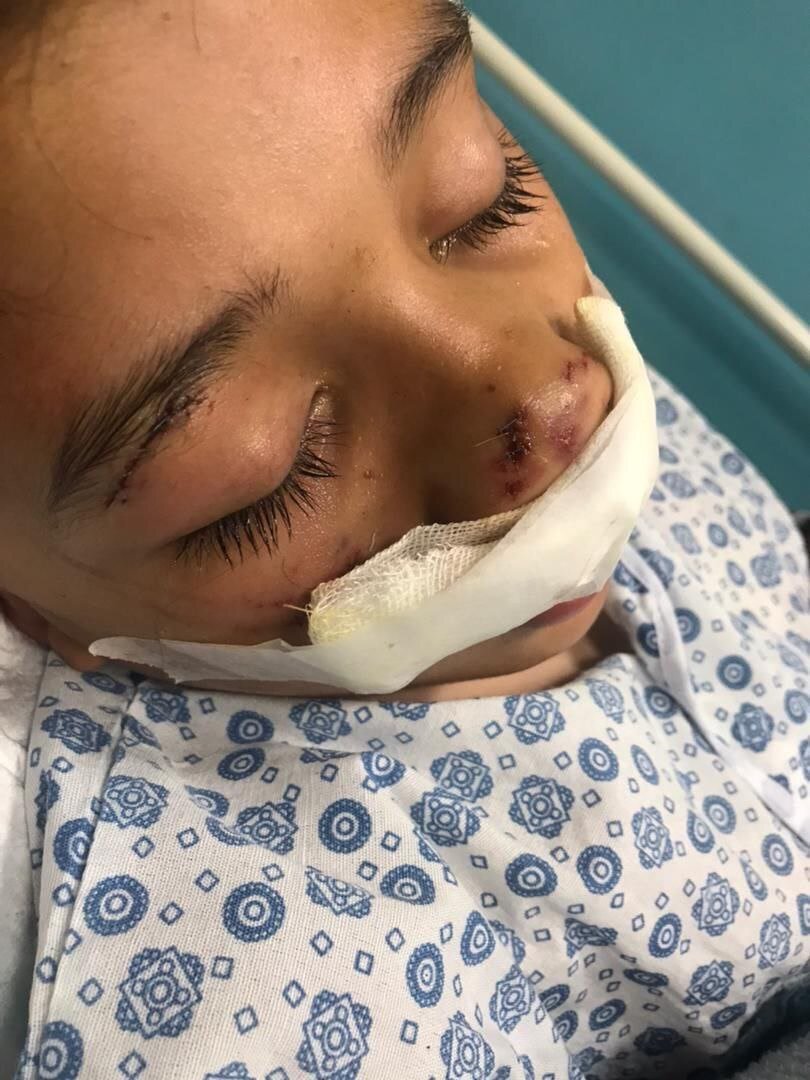 بیرون کشیدن پسر بچه ۱۲ساله از میان آرواره های سگ بدون صاحب در کرج ! | تصاویر