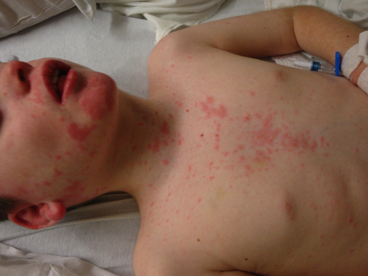 همه چیز درباره سندرم DRESS | ترانه علیدوستی در خطر است؟