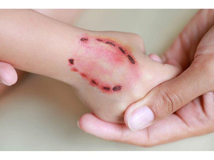 با عوارض ناشی از گازگرفتگی حیوانات چه باید کرد؟