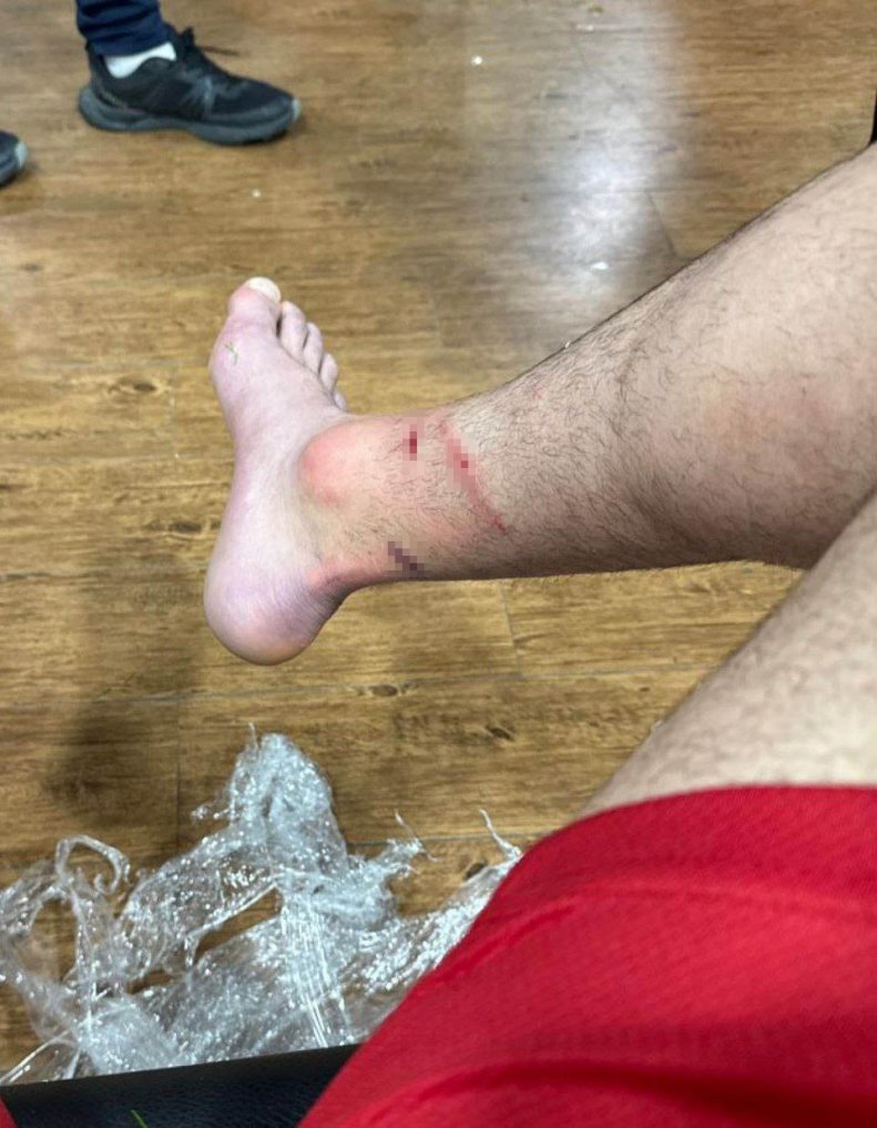 سپاهانیها اورونوف را به چه روزی انداختند | تصاویری از پای زخمی ستاره پرسپولیس بعد از بازی حساس | داور حتی کارت زرد هم نداد