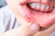 فرق آفت و سرطان دهان | تشخیص فوری و درمان خانگی