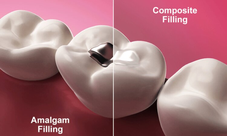 ترمیم دندان در کلینیک دندانپزشکی ماکان با تجهیزات روز دنیا
