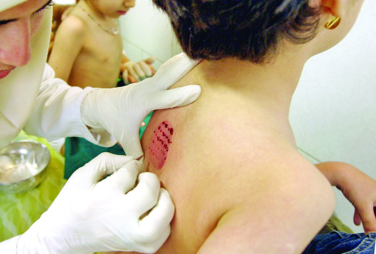 آیا کودکان را می توان حجامت کرد؟ | عوارض حجامت خودسرانه کودکان