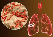 سونامی بیماری سل در ایران ؛ بیش از ۷ هزار نفر مبتلا شدند | ۷ علامت ابتلا به سل + راه‌های پیشگیری | آیا سل درمان می‌شود؟