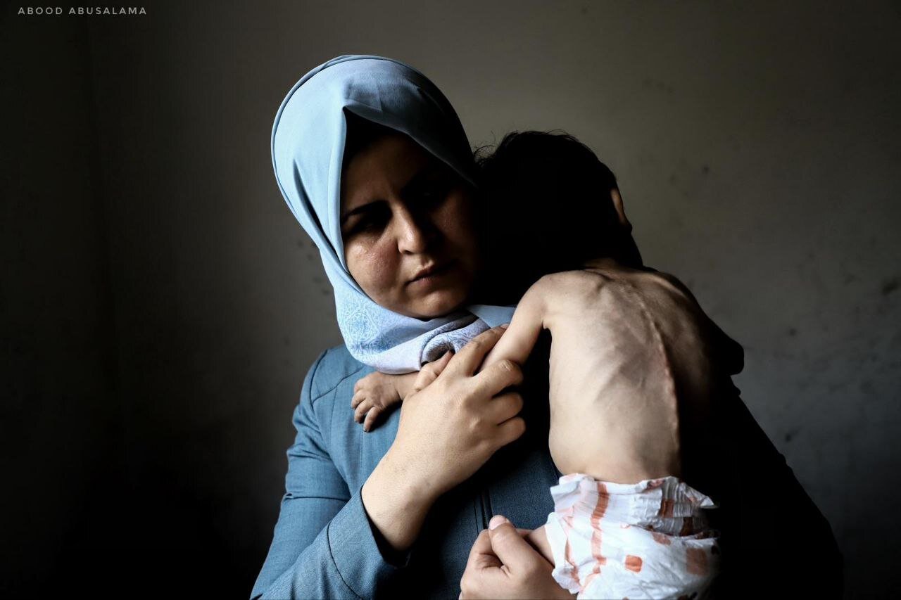 تصاویری رقتانگیز از شرایط بحرانی کودک سه ساله در جبالیا