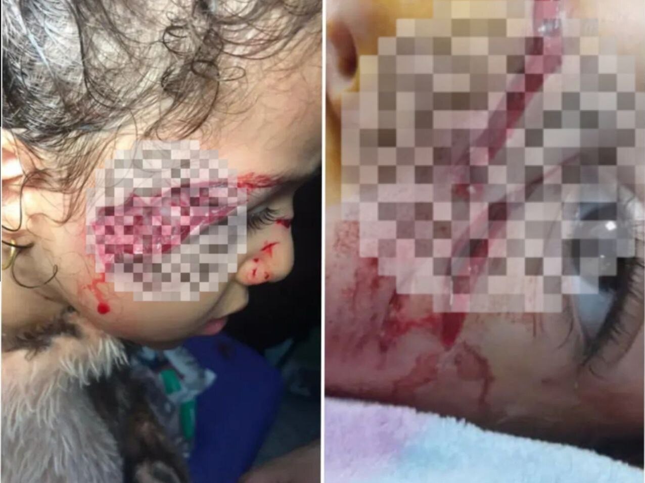 حمله سگ‌های ولگرد ‌به دختر ۵ ساله تبریزی + عکس
